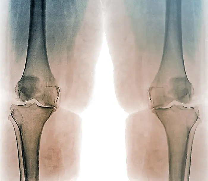 Osteoartritis de rodilla en la obesidad