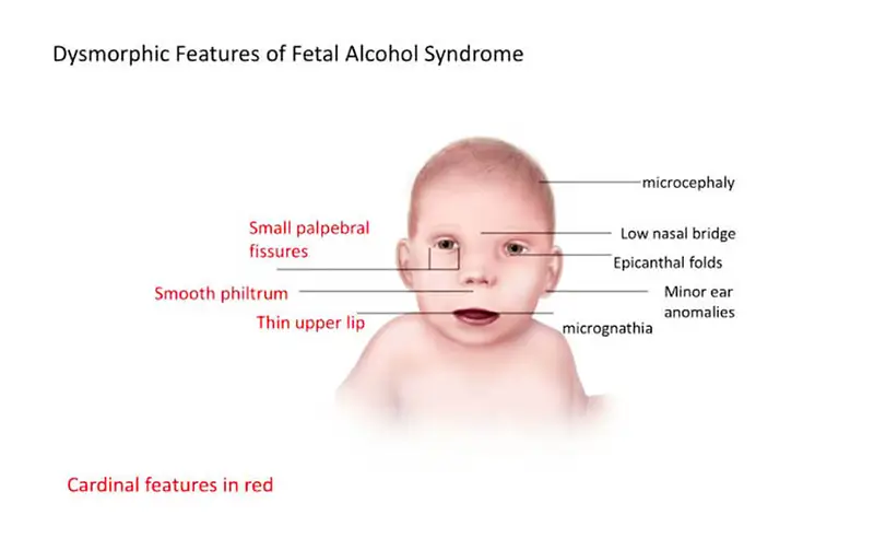 dysmorphic-features-of-fetal-alcohol-syndrome-n