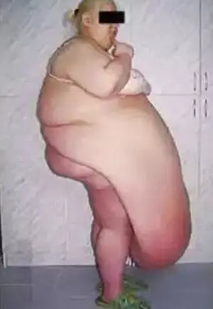 obesidade mórbida