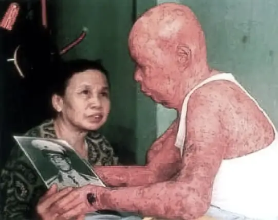 Agent Orange dioxin skin damage Vietnam