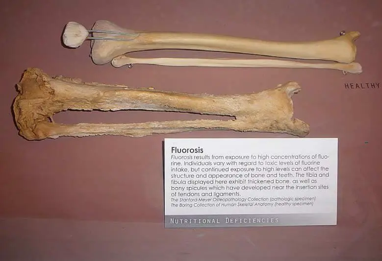 B-Severely-fluorotic-humano-leg-bone-in-a-victim-of-stage-III-skeletal-fluorosis-is