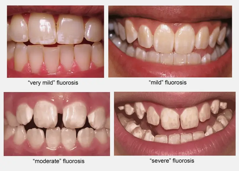 Fluorosis dental