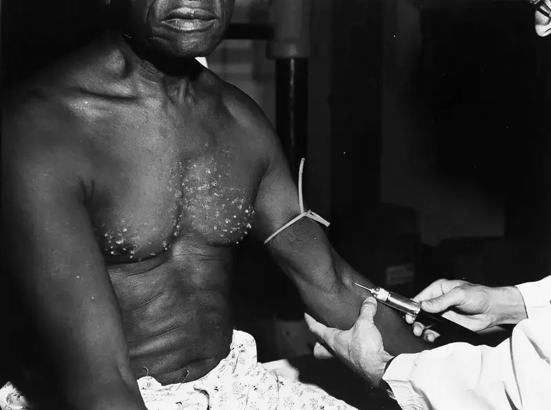 Tuskegee syphilis experiment 1 | GoVeganWay.com