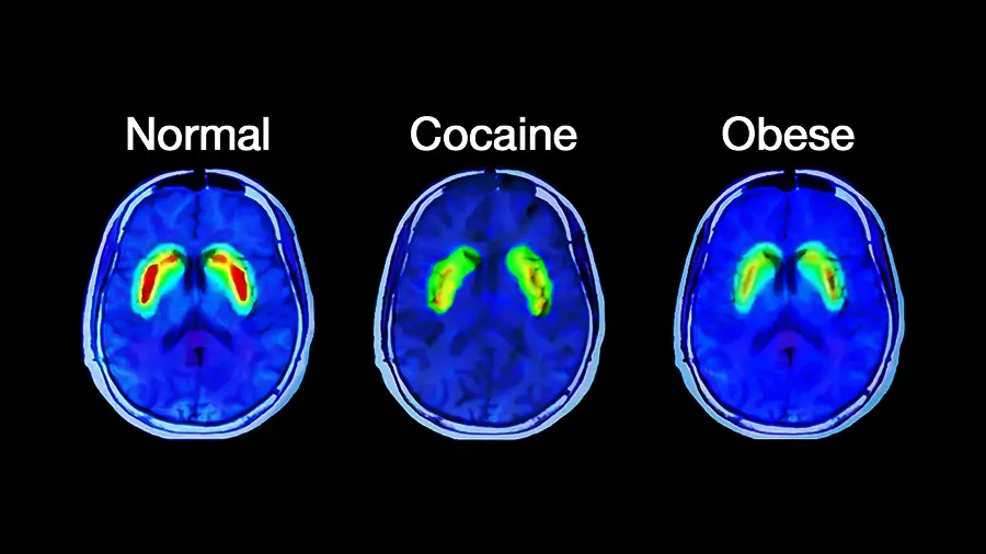 нормальная передача сигналов дофамина в мозг при ожирении от кокаина