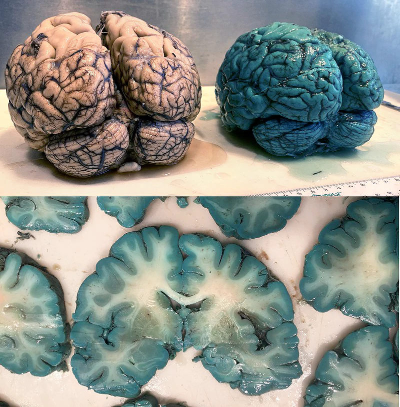 brain_of_patient_treated_with_methylene_blue_before_death