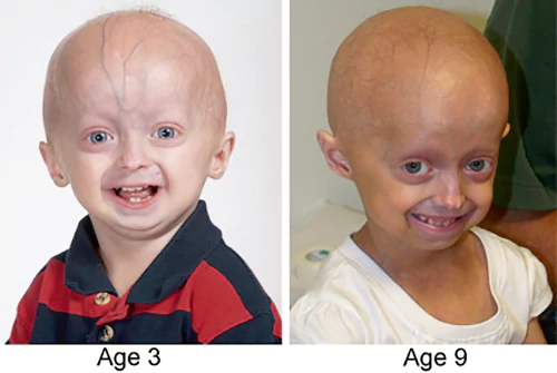Síndrome de progeria de Hutchinson-Gilford.
