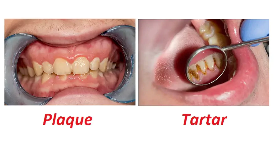 Zahnbelag und Zahnstein