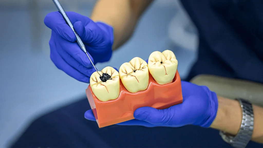 虫歯を止める方法： 症状、原因、予防
