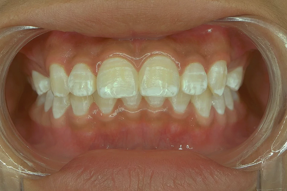 Белые пятна на зубах-Деминерализация